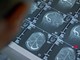 Fenilchetonuria, 'screening neonatale evita danni neurologici ma serve continuità assistenziale'