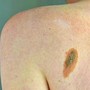 Melanoma, Adoi: "Bene nuova legge su prevenzione, dermatologo centrale in screening" Melanoma, Adoi: "Bene nuova legge su prevenzione, dermatologo centrale in screening"