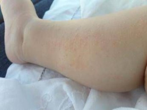 Dermatite atopica, Aifa estende rimborso di upadacitinib dai 12 anni di età