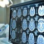 Telemedicina, progetto telestroke permette di trattare ictus a distanza