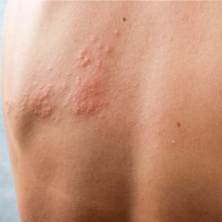 Vaccini: 1 over 50 su 2 con cronicità non parla col medico di Herpes Zoster Vaccini: 1 over 50 su 2 con cronicità non parla col medico di Herpes Zoster