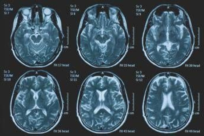 Una persona su 3 ha un disturbo neurologico, a Napoli arriva BrainSpace House
