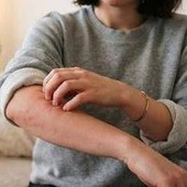Malattia della pioggia, perché se ne parla: cos'è e sintomi Malattia della pioggia, perché se ne parla: cos'è e sintomi
