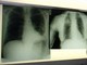Bpco, ok dell'Ema alla prima terapia con propellente green
