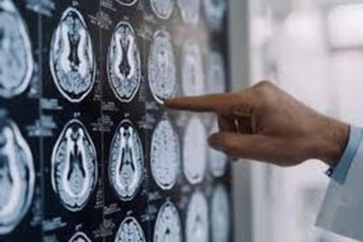 Malattia di Parkinson, ok in Europa a formulazione orale Ld/Cd a rilascio modificato Malattia di Parkinson, ok in Europa a formulazione orale Ld/Cd a rilascio modificato