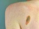 Melanoma, Adoi: "Bene nuova legge su prevenzione, dermatologo centrale in screening" Melanoma, Adoi: "Bene nuova legge su prevenzione, dermatologo centrale in screening"