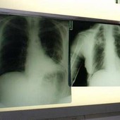 Cancro polmone, con nuova combinazione malattia sotto controllo più a lungo