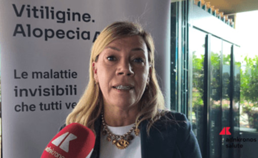 Cordella (AbbVie): "Vitiligine e alopecia siano riconosciute da Ssn" Cordella (AbbVie): "Vitiligine e alopecia siano riconosciute da Ssn"