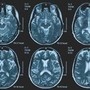 Una persona su 3 ha un disturbo neurologico, a Napoli arriva BrainSpace House