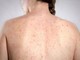 Morbillo, l'allarme dell'infettivologo Andreoni: "Casi in crescita, ricoveri frequenti negli adulti" Morbillo, l'allarme dell'infettivologo Andreoni: "Casi in crescita, ricoveri frequenti negli adulti"