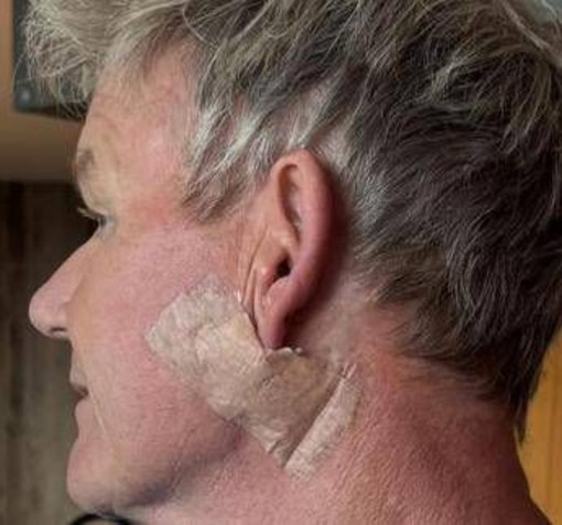 Gordon Ramsay: &quot;Operato per tumore della pelle&quot;