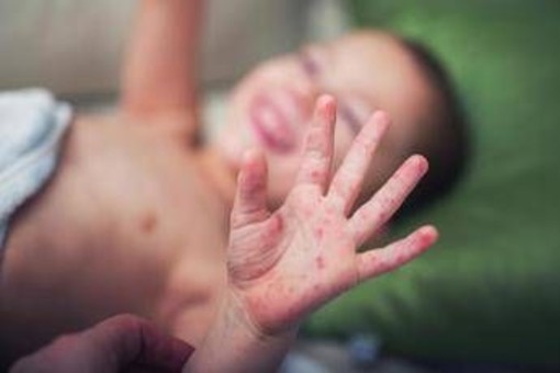 Morbillo, aumentano casi e ricoveri. Bassetti: "In Liguria focolaio senza precedenti, l'Italia rischia gravissima epidemia"