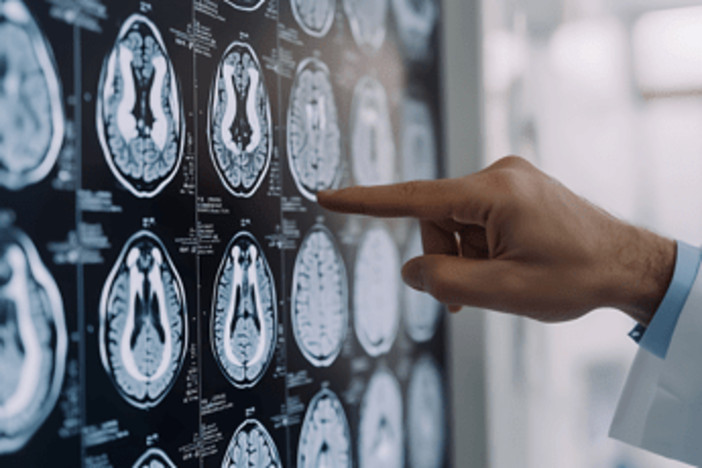 Parkinson, ansia e depressione possono essere segnali precoci: lo studio Parkinson, ansia e depressione possono essere segnali precoci: lo studio