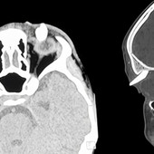 Ha un gonfiore sotto l'occhio, in ospedale scoprono che ha un dente nella palpebra: lo strano caso in India Ha un gonfiore sotto l'occhio, in ospedale scoprono che ha un dente nella palpebra: lo strano caso in India