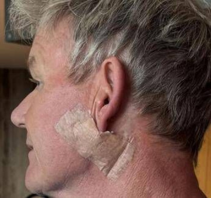 Gordon Ramsay: &quot;Operato per tumore della pelle&quot;