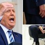 Trump e le gambe gonfie, cos'è l'insufficienza venosa cronica